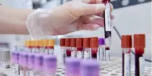 Cancro al seno, oncologi: "Bene test genomici nei nuovi Lea, fare presto"