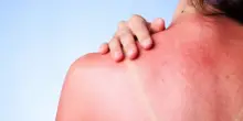 Scottature solari, rimedi e consigli su come dormire
