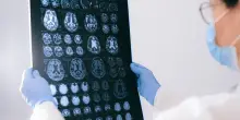 Alzheimer e Parkinson, trovate le spie: la scoperta che cambia tutto