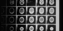 I tumori? Riconoscibili dal loro odore