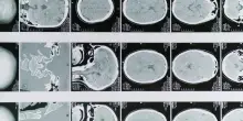 Glioblastoma, le molecole naturali migliorano la chemioterapia