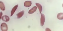 Leucemia mieloide, cos’è la malattia di Polonara e sintomi