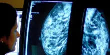 Tumore al seno, così funzionano le mutazioni genetiche responsabili e i test da eseguire
