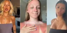 Su TikTok spopola l’”abbronzatura selvaggia” con la gara a mostrare le scottature solari, l’esperto avverte: “È una moda pericolosissima, si rischia il cancro”