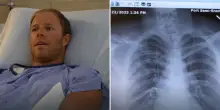 “Ho pensato di morire, sono salvo per miracolo”: scalatore colpito da un masso grande quanto un microonde, viene operato d’urgenza