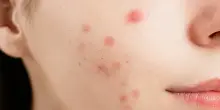 “Hai i brufoli, non puoi essere bella”: cos’è l’acne shaming, il trend tossico che sta devastando la Gen Z su TikTok