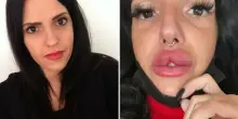 «Ho preso appuntamento sui social con una dottoressa bulgara per un filler alle labbra: era illegale. Volevo risparmiare invece mi ha sfigurata»