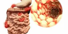 ?Malattie Infiammatorie Croniche Intestinali: in aumento tra gli under 20, in 15 anni +25%