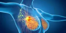 Tumore al seno avanzato, terapia ormonale di nuova generazione riduce il rischio di morte