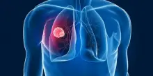 «Mi dicevano che era solo tosse cronica, poi la diagnosi»: il cancro ai polmoni non colpisce più solo i fumatori, il nuovo nemico è nell?aria
