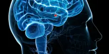 Sla, uomo paralizzato dalla malattia parla in modo fluido grazie all'IA: i microelettrodi nel cervello "traducono" i segnali cerebrali in parole