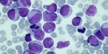 Leucemia mieloide, il tumore di Achille Polonara: cause, sintomi, fattori di rischio, diagnosi e terapia