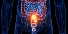 Tumore al colon-retto, una combinazione di farmaci rende la malattia sensibile all'immunoterapia: lo studio