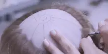 «Il tumore al seno a 28 anni, la chemio, i capelli persi. La protesi mi ha restituito il sorriso, ho ritrovato il coraggio di sognare»