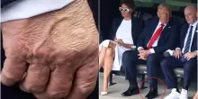 Donald Trump ha un'insufficienza venosa cronica. Il medico: «Ecco il motivo delle caviglie gonfie. I lividi? Colpa delle frequenti strette di mano»