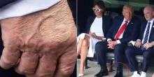 Donald Trump, le gambe gonfie e i lividi sulle mani: ecco cos'è l'insufficienza venosa cronica diagnosticata al presidente Usa