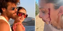 Sara Bluma denuncia le violenze dell'ex, il fidanzato Can Yaman: «Ti amo e ti sosterrò. Non lo ha tradito con me». Le foto con le ferite