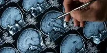 Alzheimer e Parkinson, scoperte le spie molecolari. «Permettono diagnosi precoci». Lo studio record su 35mila campioni
