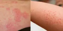 Scabbia, boom di casi in Italia: «È molto contagiosa, occhio ai materassi. Le papule escono soprattutto su mani, piedi e genitali»