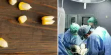 Bambino di 2 anni rischia di morire per un chicco di mais mangiato giorni prima, tra i sintomi tosse e difficoltà respiratoria: cosa è successo