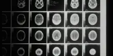 Tumore al cervello, una nuova terapia 'personalizzata' contro il glioblastoma: rallenta nel 70% dei casi