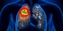 Tumori, è allarme: i morti di cancro supereranno i 18 milioni nel 2050 (+75%), lo studio su Lancet. Dal fumo alla dieta, come prevenirli