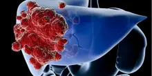 Intelligenza Artificiale e malattie del fegato, il Convegno Nazionale del Club Epatologi Ospedalieri a Foggia