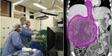 Tumore, ultrasuoni come cura: la scoperta casuale che sta rivoluzionando la medicina. Cosa è l'istotripsia e come funziona