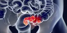 Tumore al colon, prevenzione: l'analisi del microbioma con l'intelligenza artificiale spiegabile (Xai) può predire rischio