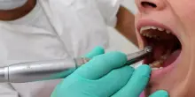 Ictus, con carie e malattie gengivali rischio raddoppiato. «Prendersi cura dei denti può salvare la vita»