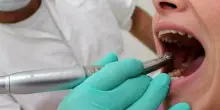Ictus, con carie e malattie gengivali rischio raddoppiato. «Prendersi cura dei denti salva la vita»