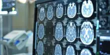 Neoplasie cerebrali, in Italia ogni anno 3mila casi di glioma