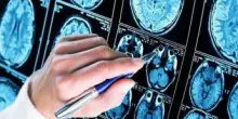 Farmaci, ok Ema a donanemab, neurologi: "Svolta in lotta all'Alzheimer"