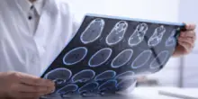 Sclerosi multipla per 144mila italiani, 10% è fuori da percorsi cura e assistenza