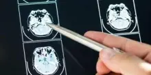 Intelligenza Artificiale può prevedere evoluzione Parkinson, lo studio italiano