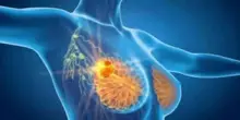 Cancro seno, con profilazione molecolare e terapie target migliori prospettive di cura