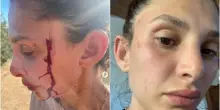 Sara Bluma e le foto delle violenze domestiche: “Troppo tempo in silenzio”. Can Yaman: “Sono con te”
