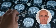 Il tumore al cervello si può combattere? Uno studio dell'Università di Padova dice di sì