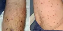 Trattore colpisce un nido di vespe. Agricoltore viene punto 250 volte