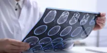 Sclerosi multipla per 144mila italiani, 10% è fuori da percorsi cura e assistenza