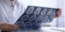 Sclerosi multipla, neurologi: "Con nuovi strumenti la diagnosi sempre più precoce"
