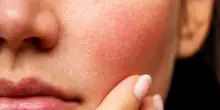 Couperose: cos’è e come curarla con i rimedi naturali