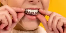 Allineatori dentali: la soluzione trasparente per un sorriso perfetto