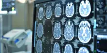Giornata mondiale dellAlzheimer, neurologi: "Ora percorsi cura più efficaci e sostenibili"