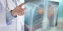 Tumori, nel 2050 i morti cancro supereranno i 18 milioni (+75%): lo studio su Lancet