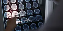 Alzheimer, ok Ue a nuovo farmaco per trattare fasi iniziali malattia