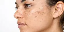 Macchie del sole sulla pelle: come difendersi naturalmente