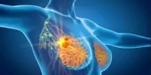 Cancro seno iniziale Her2+, con anticorpo farmaco-coniugato -53% recidiva