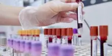 Tumori, cancro vescica: 70% pazienti libero da malattia a 2 anni con terapie perioperatorie