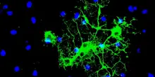 Sclerosi multipla, scoperto nuovo meccanismo di declino cerebrale